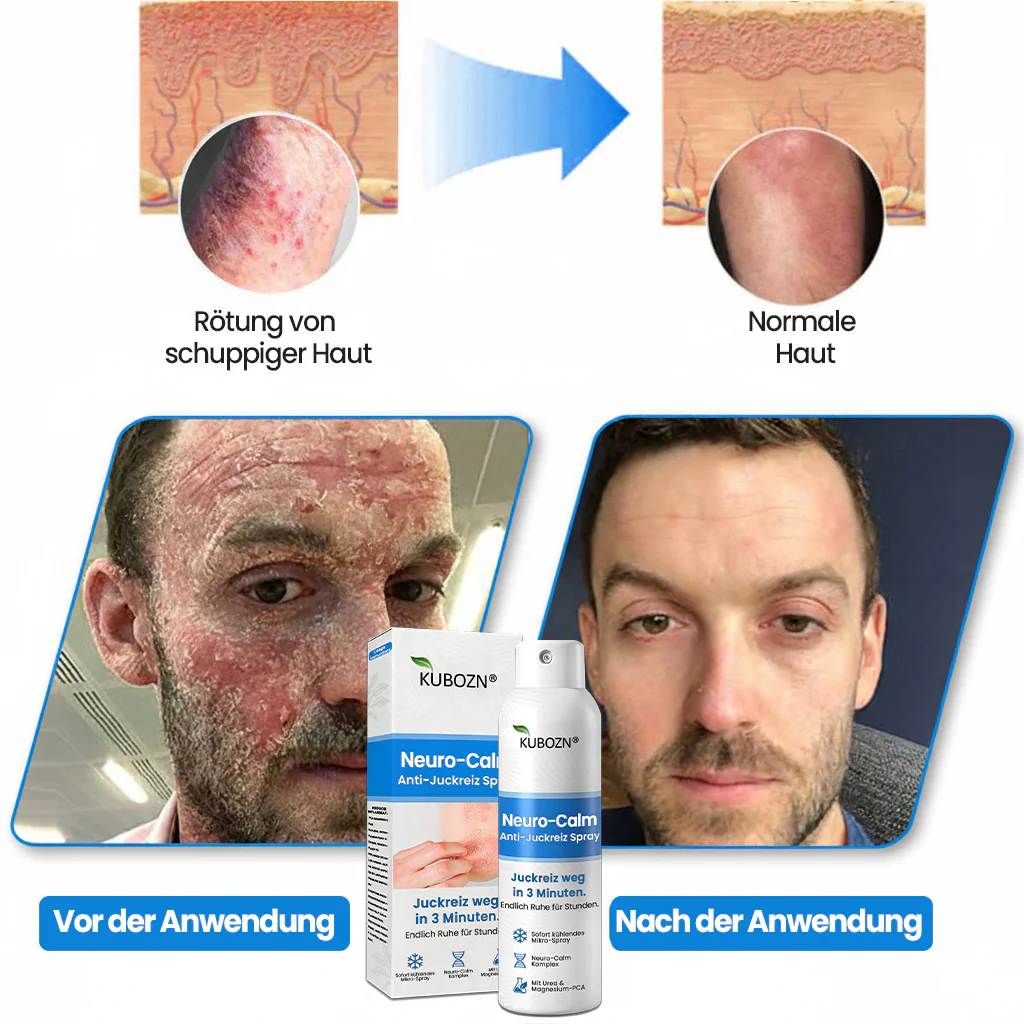 ✅KUBOZN® Neuro-Calm Anti-Juckreiz Akut-Spray – 3-Minuten-Ruhe bei Juckreiz - Image 3