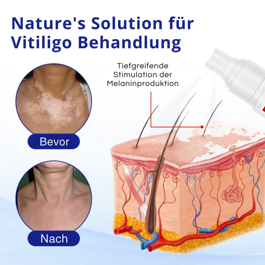 KUBOZN® Spray gegen Vitiligo — Dermatologisch getestet, pflanzlich & steroidfrei - Image 4