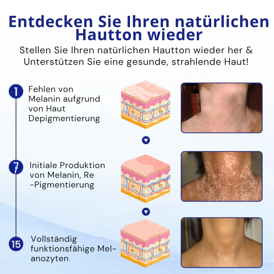 KUBOZN® Spray gegen Vitiligo — Dermatologisch getestet, pflanzlich & steroidfrei - Image 6